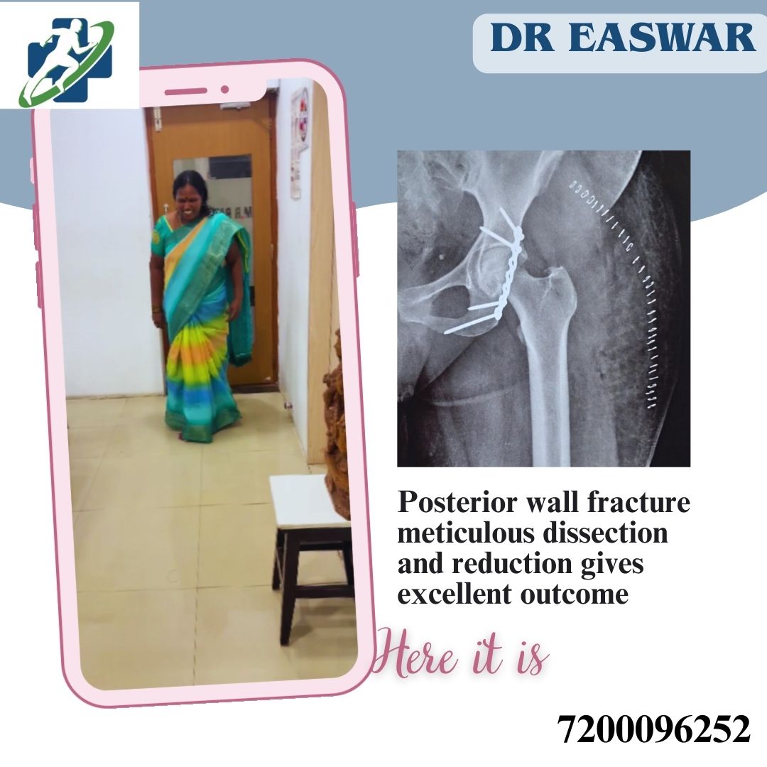Posterior Wall Acetabulum Fracture